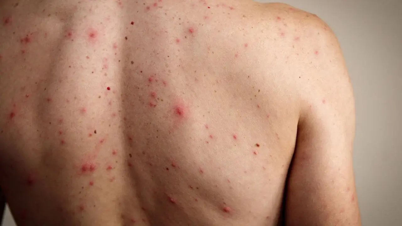 Jalisco ordena uso de cubrebocas en escuelas por brote de sarampión