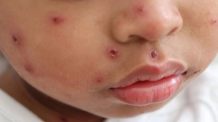 Gobierno de CDMX confirma segunda muerte por sarampión